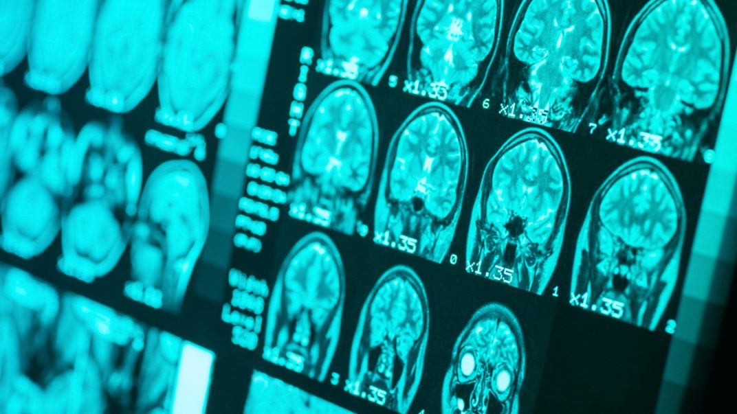 MRI imaging of a healthy brain