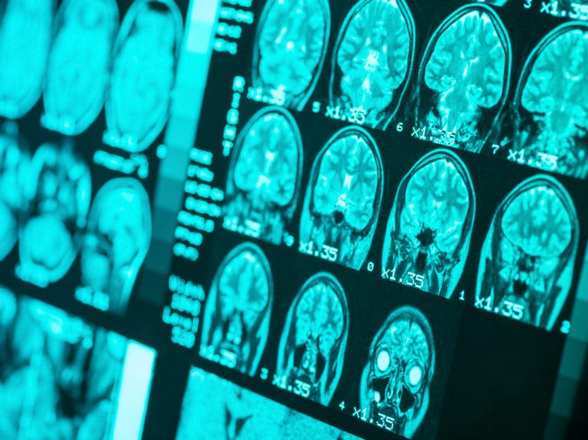 MRI imaging of a healthy brain