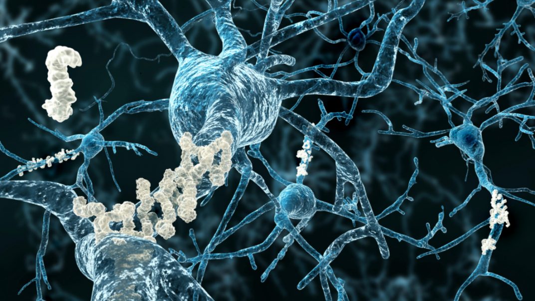 What is Alzheimer disease? 1 3-D Amyloid beta plaques on brain neurons in Alzheimer disease